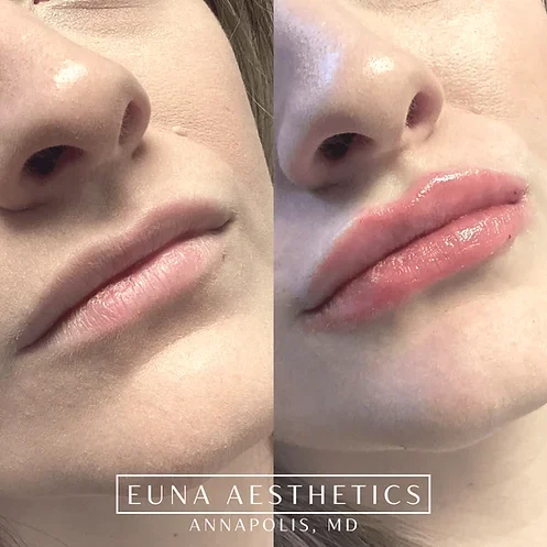 Helloeuna_Dermal_Filler_Seven_ by Euna Aesthetics LLC in Annapolis, MD