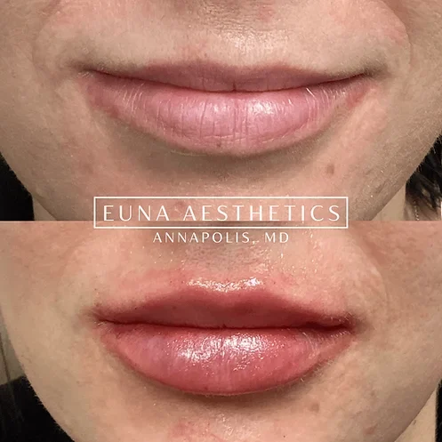 Helloeuna_Dermal_Filler_Six_ by Euna Aesthetics LLC in Annapolis, MD