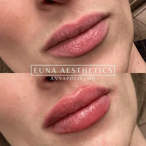 Helloeuna_Dermal_Filler_Three_ by Euna Aesthetics LLC in Annapolis, MD