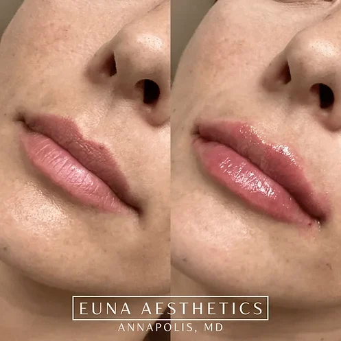 Helloeuna_Dermal_Filler_Two by Euna Aesthetics LLC in Annapolis, MD