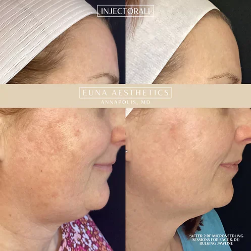 Helloeuna_Microneedling_One by Euna Aesthetics LLC in Annapolis, MD