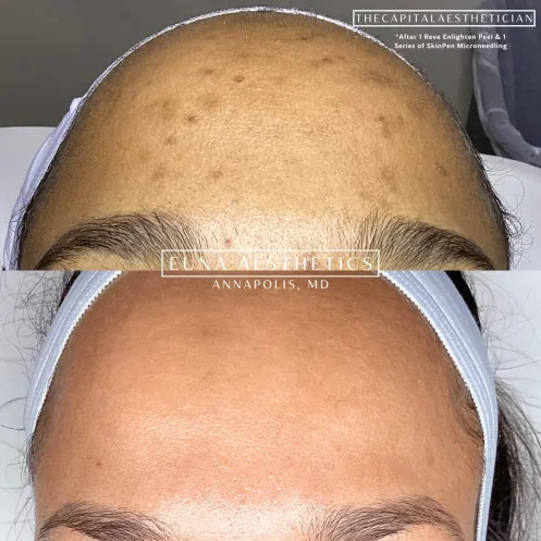 Helloeuna_Microneedling_Three _In_Annapolis_MD