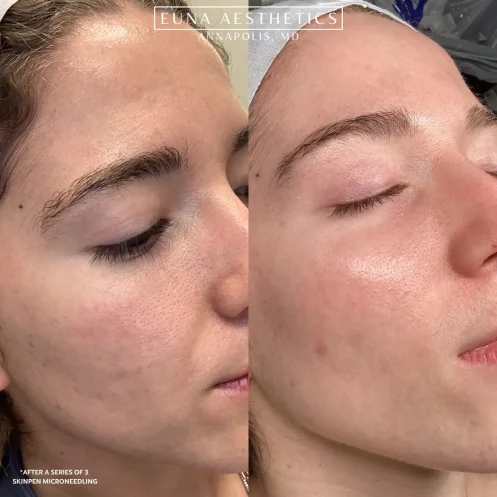 Helloeuna_Microneedling_Two-_In_Annapolis_MD