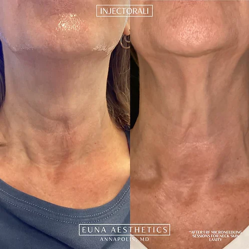 Helloeuna_Microneedling_Two by Euna Aesthetics LLC in Annapolis, MD