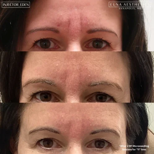 Helloeuna_Microneedling_Two_In_Annapolis_MD