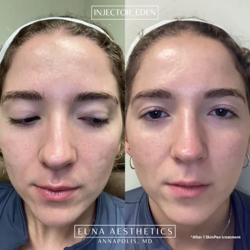 Helloeuna_Microneedling_one _In_Annapolis_MD