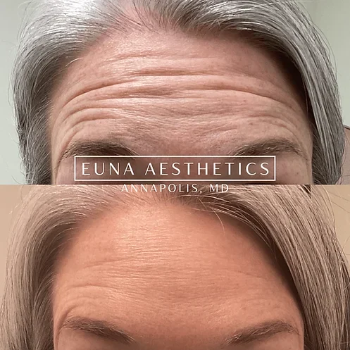 Helloeuna_Neurotoxins_Five by Euna Aesthetics LLC in Annapolis, MD