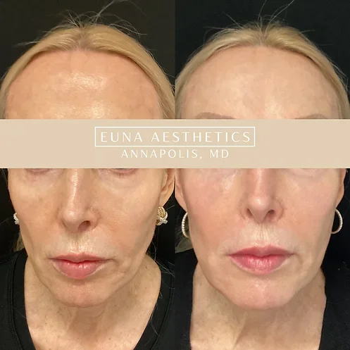 Helloeuna_Sculptra_One by Euna Aesthetics LLC in Annapolis, MD