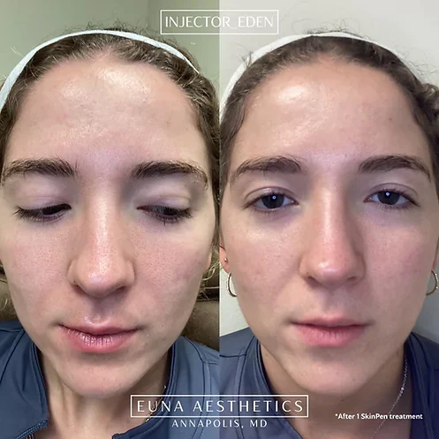 Helloeuna_Skin_Therapy_One_ by Euna Aesthetics LLC in Annapolis, MD