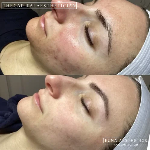 Helloeuna_Skin_Therapy_Six_ by Euna Aesthetics LLC in Annapolis, MD