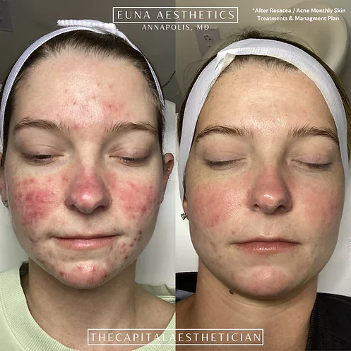 Helloeuna_Skin_Therapy_Three by Euna Aesthetics LLC in Annapolis, MD