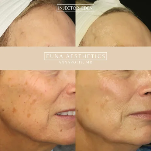 SALLY BBLANNAPOLIS MD EUNA AESTHETICSANNAPOLIS MD EUNA AESTHETICSEUNA AESTHETICS (1)