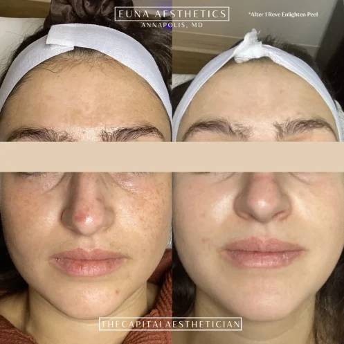 Skin Therapy_Before and After 5