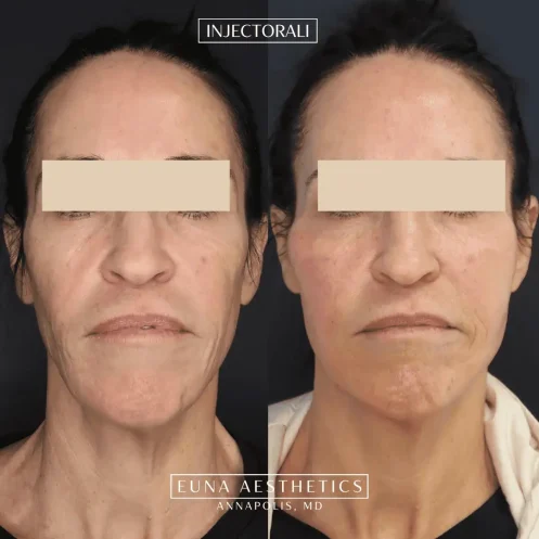 TR ScultpRadiesse in Annapolis, MD - Euna Aesthetics