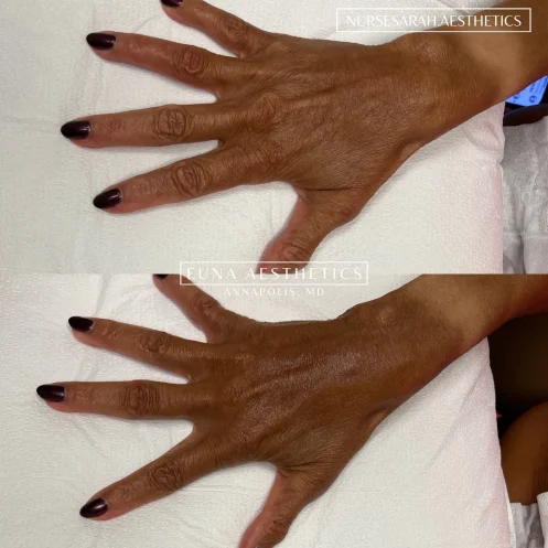 euna-sculptra